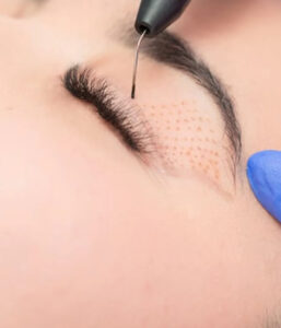 Blefaroplastia Sem Corte em Medianeira