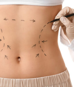 Hidrolipoclasia em Medianeira
