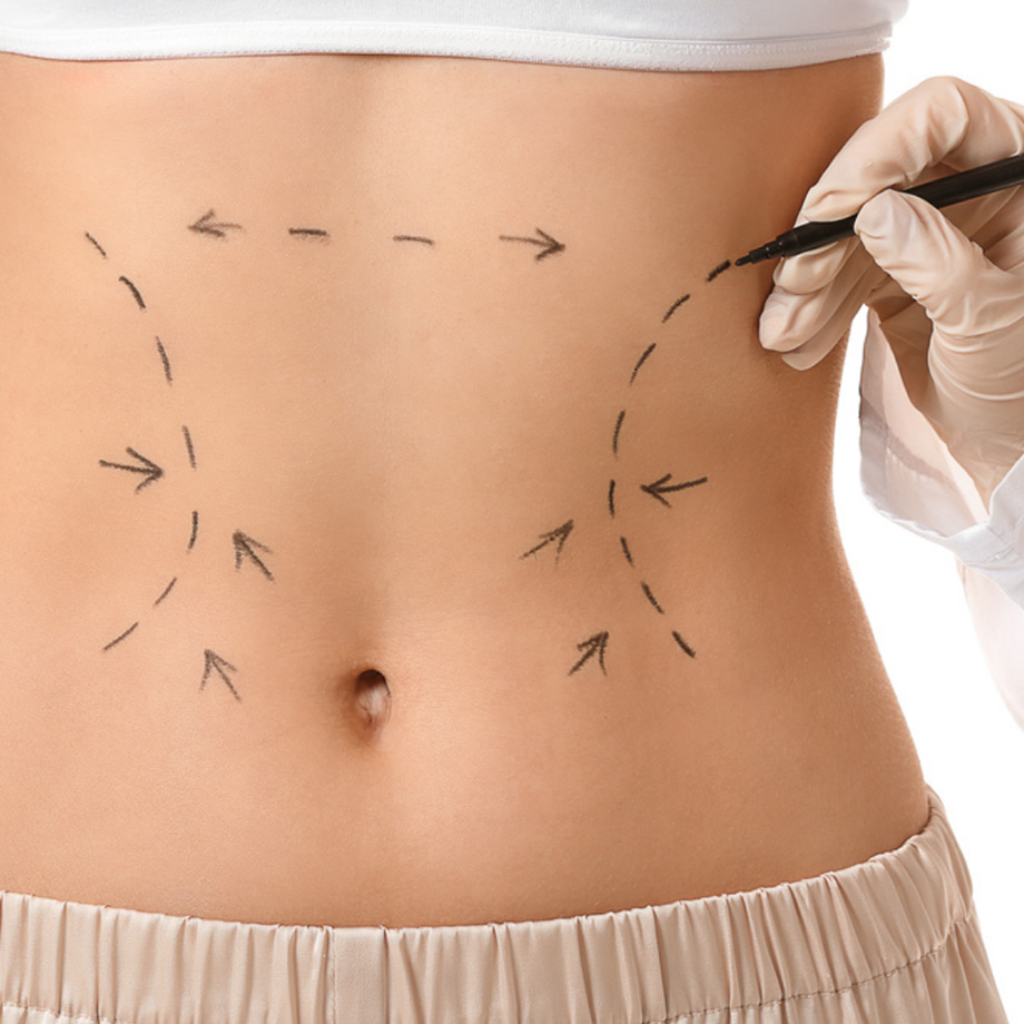 Hidrolipoclasia em Medianeira