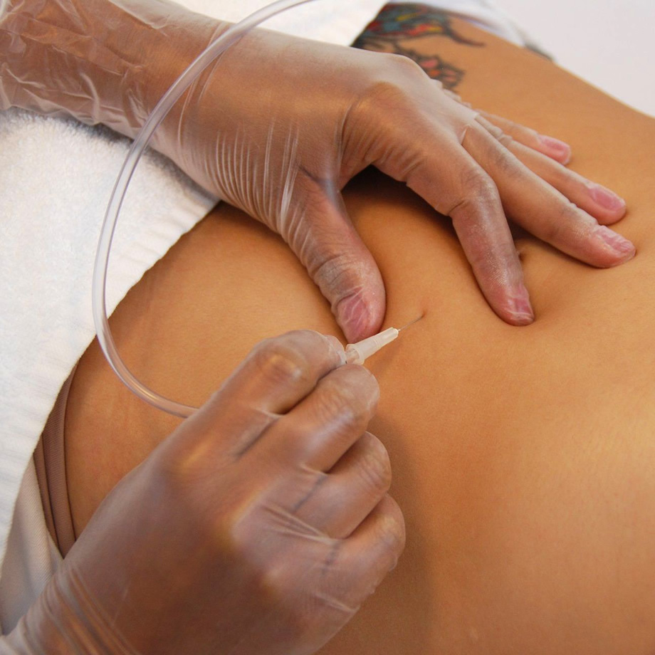 Carboxiterapia em Medianeira